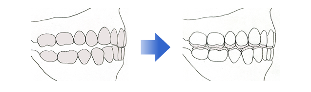 経堂（世田谷区）の歯医者、K.i歯科で、噛み合わせ症候群の治療