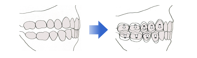 経堂（世田谷区）の歯医者、K.i歯科で、噛み合わせ症候群の治療