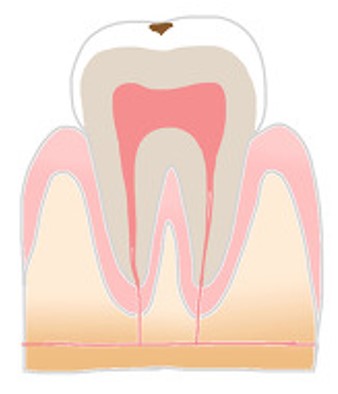 経堂（世田谷区）の歯医者、K.i歯科で、虫歯治療