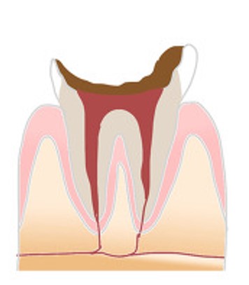 経堂（世田谷区）の歯医者、K.i歯科で、虫歯治療