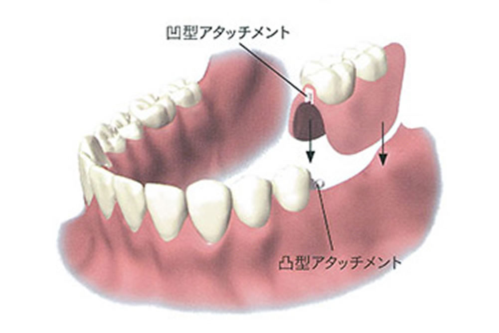 経堂（世田谷区）の歯医者、K.i歯科で入れ歯治療