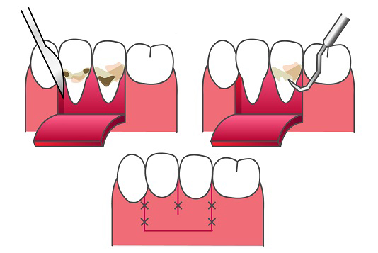経堂（世田谷区）の歯医者、K.i歯科の歯周病治療