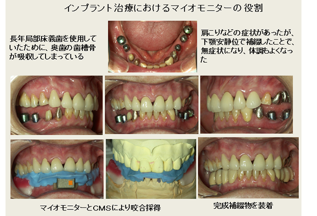 経堂（世田谷区）の歯医者、K.i歯科で、かみ合わせの検査と診断