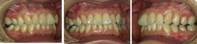 経堂（世田谷区）の歯医者、K.i歯科で、診断と治療の鍵「下顎安静位」