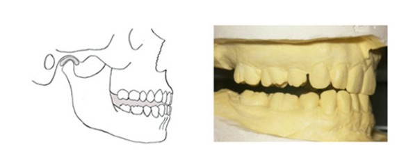 経堂（世田谷区）の歯医者、K.i歯科で、顎関節症の治療