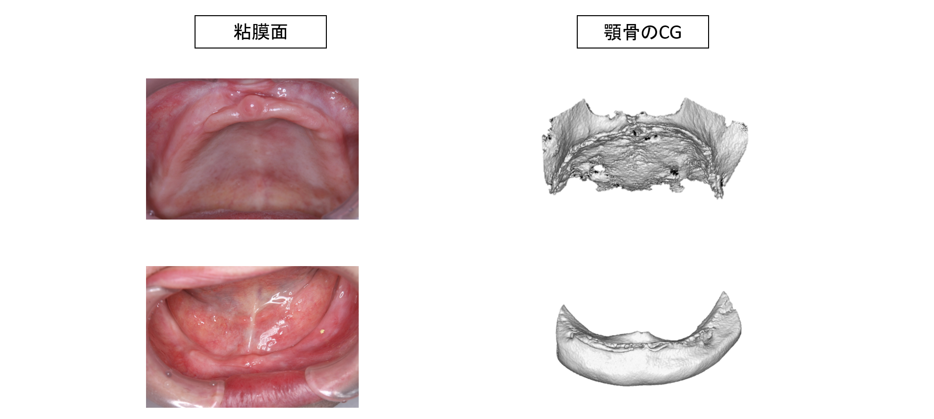 経堂（世田谷区）の歯医者、K.i歯科で、総義歯治療
